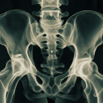 Radiografía mostrando pelvis con prótesis y columna vertebral con cambios degenerativos en paciente mayor